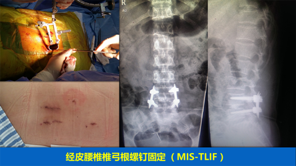 腰椎疾病的微創手術