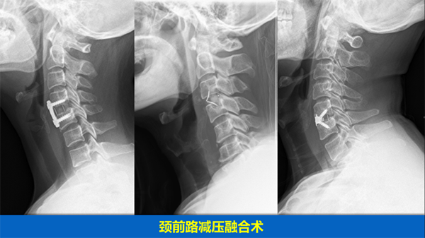 頸椎疾病的手術治療