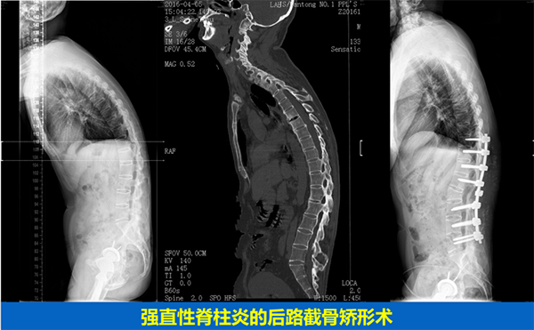 脊柱畸形的手術治療