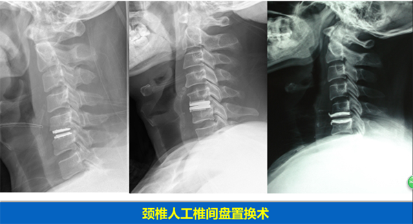 頸椎疾病的手術治療