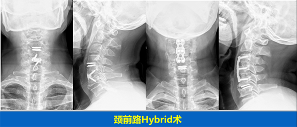 頸椎疾病的手術治療