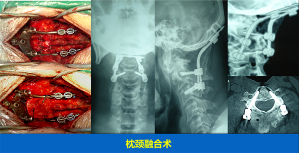 頸椎疾病的手術治療