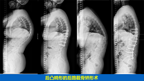 脊柱畸形的手術治療