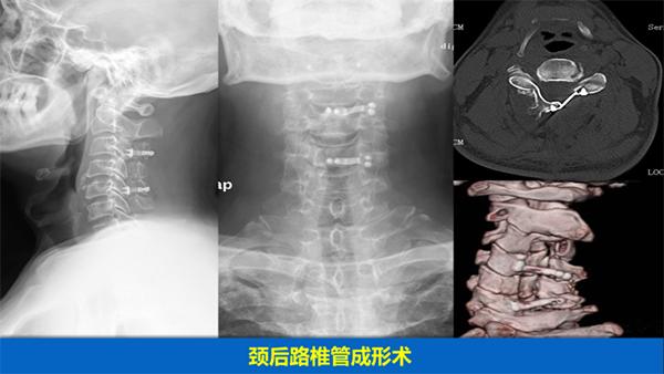 頸椎疾病的手術治療