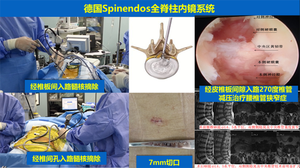 腰椎疾病的微創手術