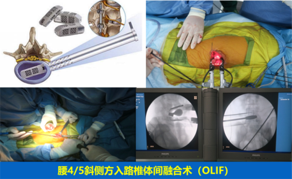 腰椎疾病的微創手術