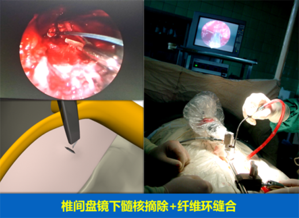 腰椎疾病的微創手術