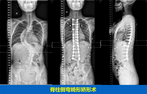 脊柱畸形的手術治療